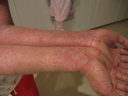 Come curare un eczema con rimedi naturali 