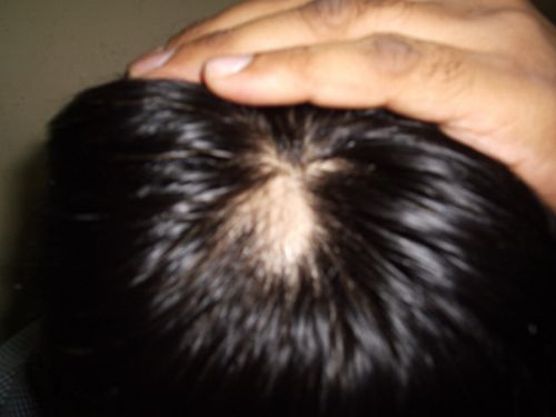 Come notare i sintomi dell'alopecia  