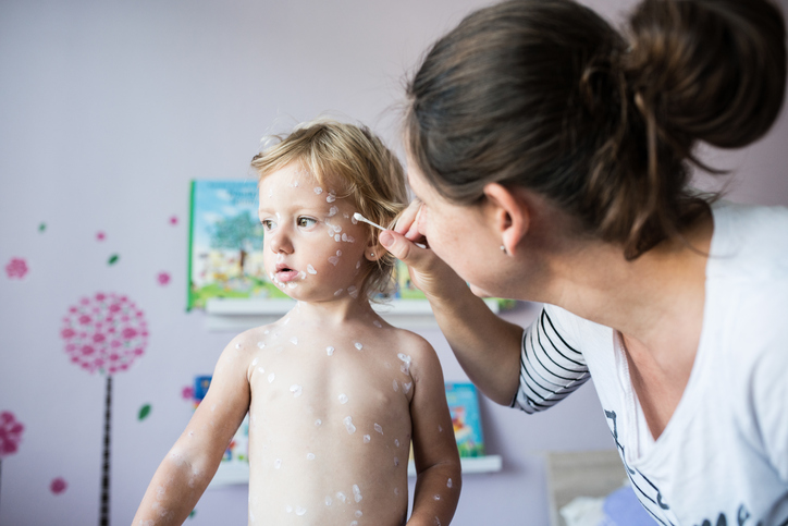 Come trattare il prurito delle bolle della varicella  