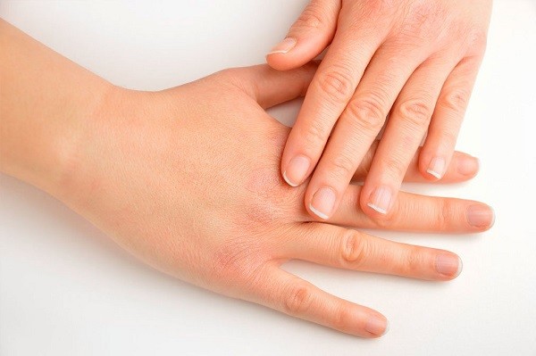 Come curare mani screpolate da igienizzante 