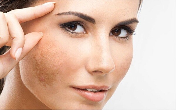 Come prevenire le macchie solari sulla pelle  
