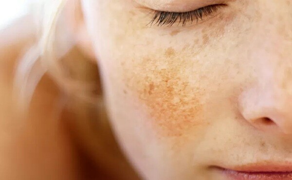 Come prevenire le macchie solari sulla pelle  